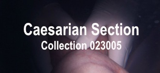 Ceasarian 023005